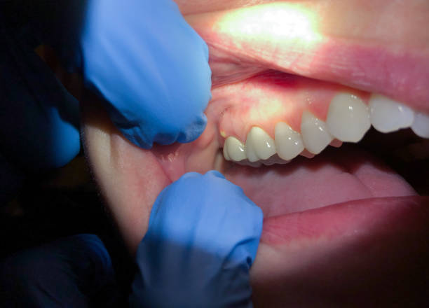Best Emergency Dental Care for Abscessed Tooth in Walnut Creek, OH