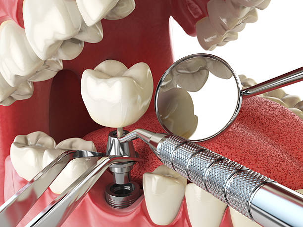 Best Emergency Dentist for Lost Fillings or Crowns in Walnut Creek, OH